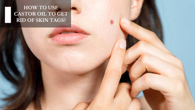 How To Use Castor Oil To Get Rid Of Skin Tags?