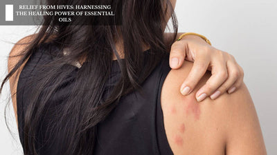 Relief From Hives: Harnessing The Healing Power Of Essential Oils